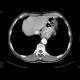 Carcinoma of oesophagus and cardia: CT - Computed tomography